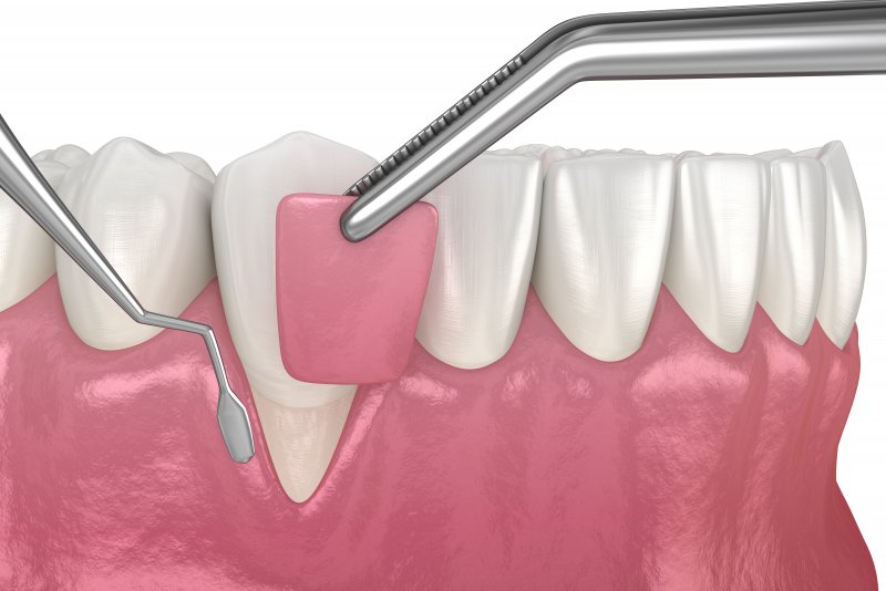 How Gum Surgery Can Help Treat Advanced Gum Disease