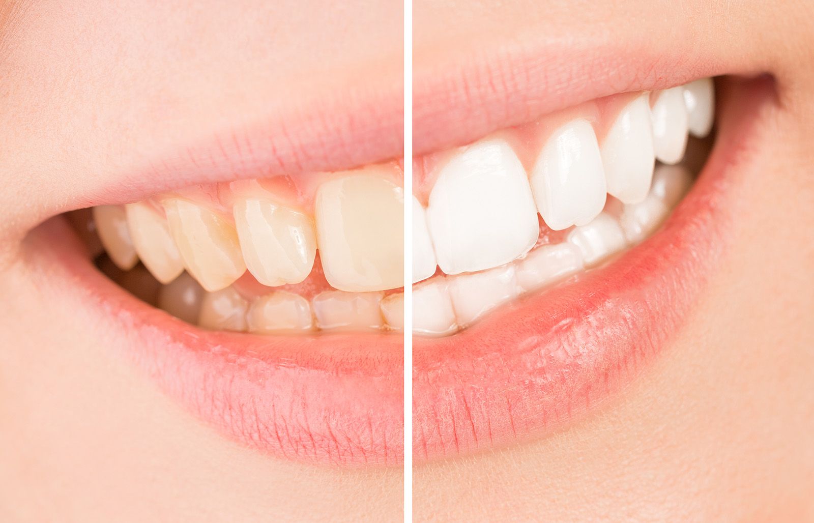 Brown Stains from Teeth