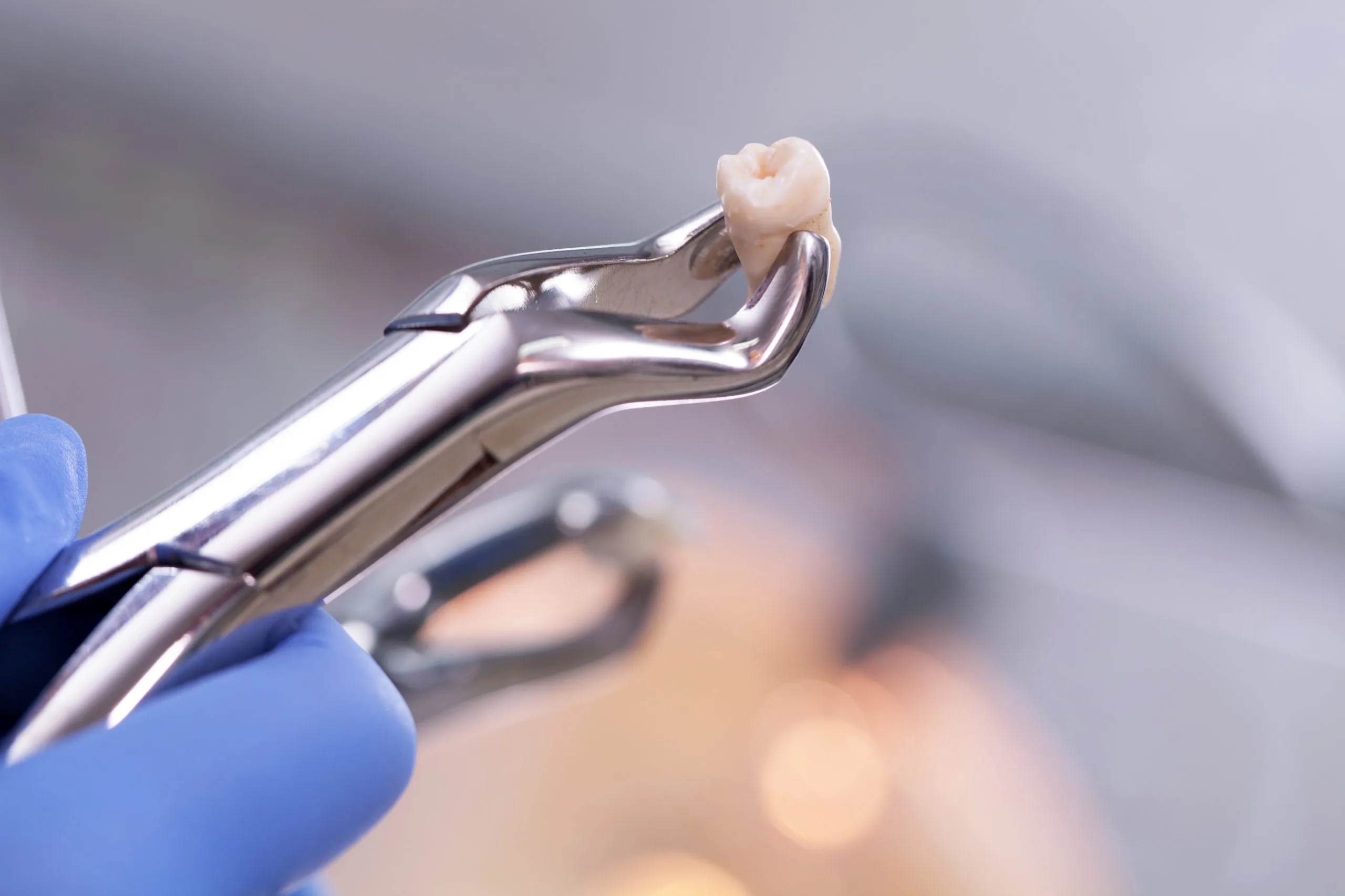 Tooth Extraction Cost in Cypress