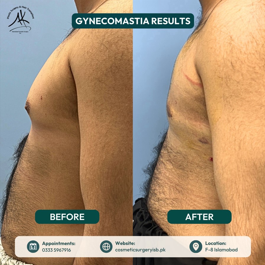 best gynecomastia surgeon in islamabad