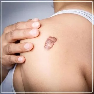 Effective Solutions for Keloid Treatment in Riyadh Today