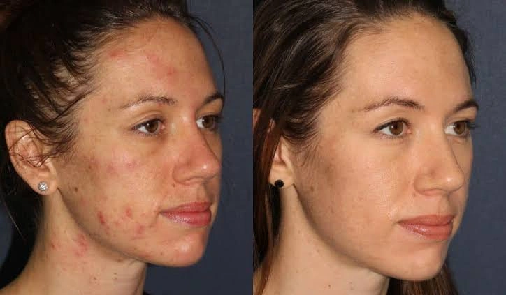 Photodynamic Therapy Actinic Keratosis Treatment Effectiveness